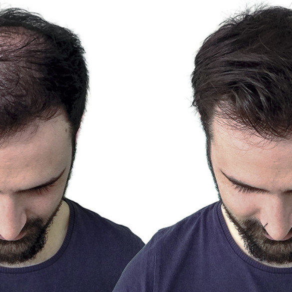 Fibras capilares: lo último contra la caída del cabello