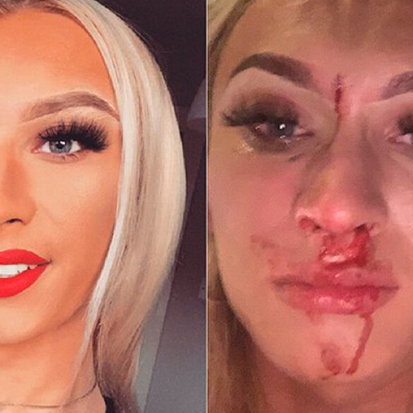 Brutal agresión a una mujer trans: "Me golpeó repetidamente en la cara"