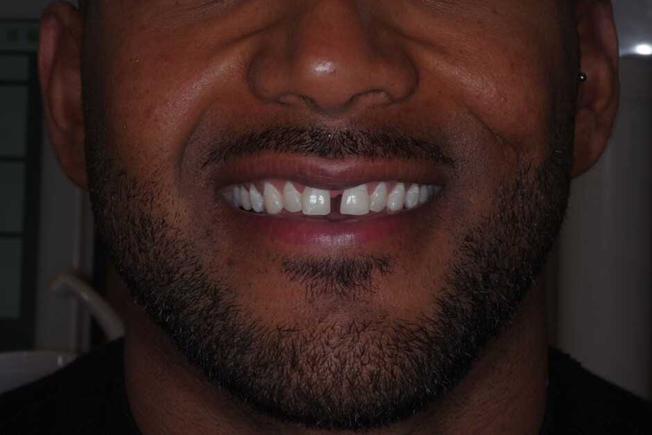 Carillas dentales antes y después - Carlos Saiz Smile