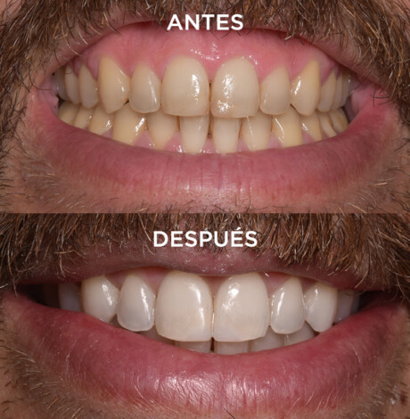 Antes y después del tratamiento por posicionamiento de labios