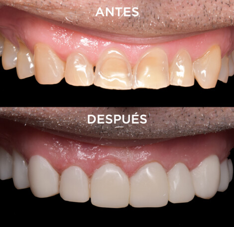 Antes y después de un tratamiento de rejuvenecimiento dental 