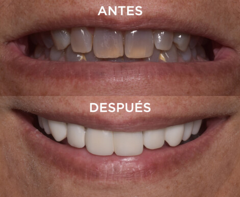 Antes y después del tratamiento dental por tetraciclinas