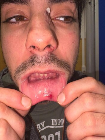 Ramón tras ser agredido en Pontevedra.